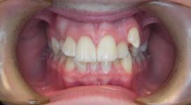 Alyssa-Before-Teeth