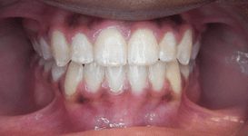 Amir-After-Teeth