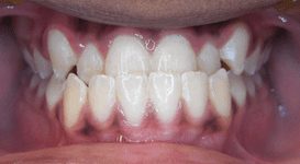 Amir-Before-Teeth