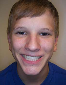 Dillon-After-Face