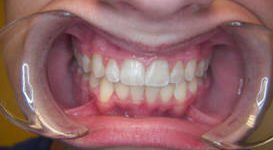 Dillon-After-Teeth
