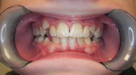 Dillon-Before-Teeth