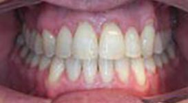 Elijah-After-Teeth