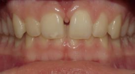 Julia-Before-Teeth