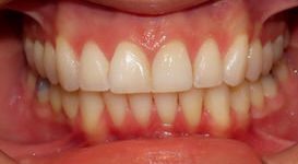 Leah-After-Teeth
