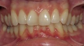 Leah-Before-Teeth