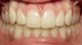 Lula-After-teeth