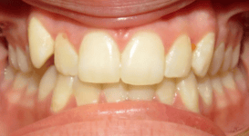 Lula-Before-teeth