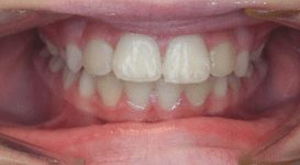 Mara-After-Teeth