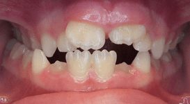 Mara-Before-Teeth