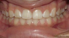 Marin-After-Teeth