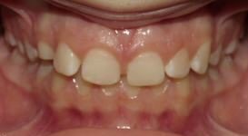 Marin-Before-Teeth