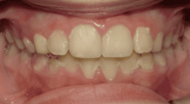 Merydith-After-Teeth