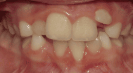 Merydith-Before-Teeth