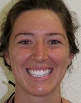 alyssa-after-face