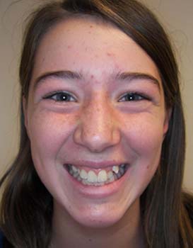alyssa-before-face